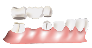 Dental Bridge