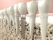 Dental Implant Photo