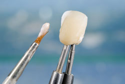 Veneers for Teeth